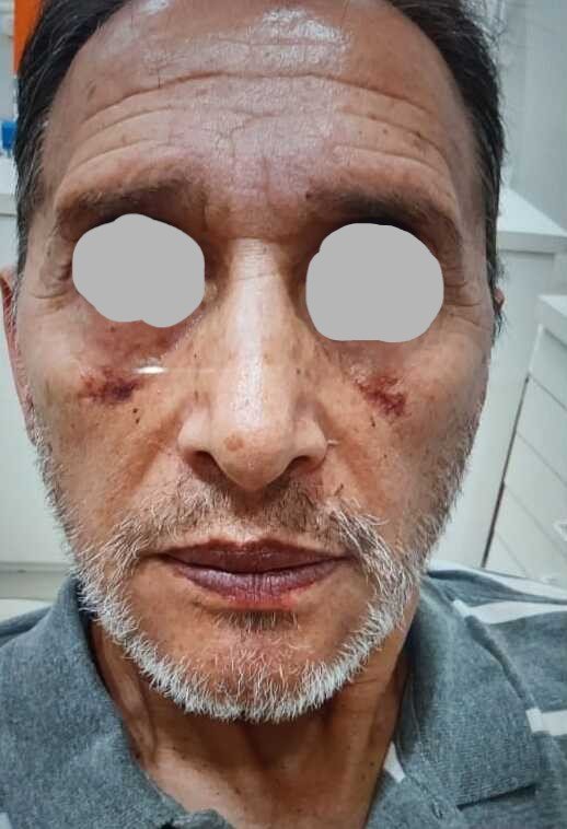Chin surgery after