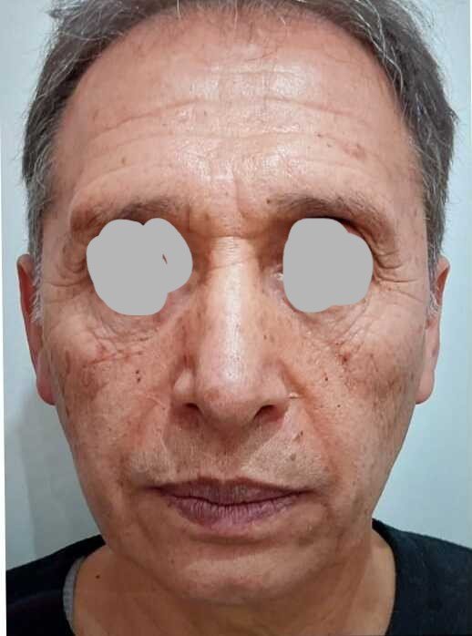 Chin surgery before