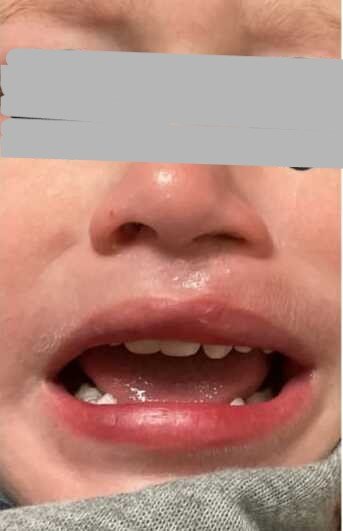 Reconstruction after