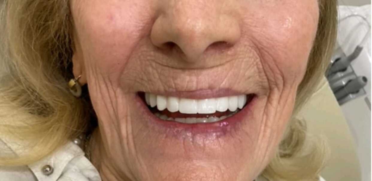 Full mouth rehabilitation after