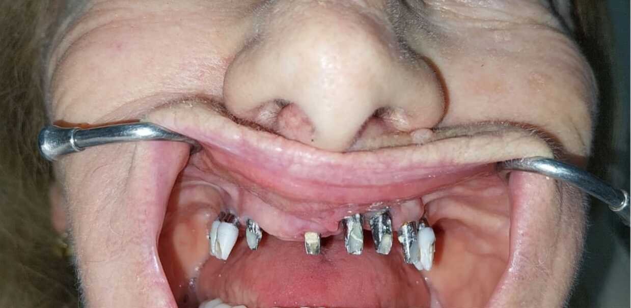 Full mouth rehabilitation before