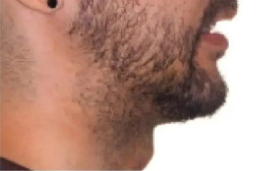 Jawline contouring after