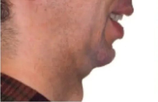 Jawline contouring before
