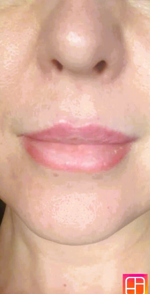 Lower face harmony after