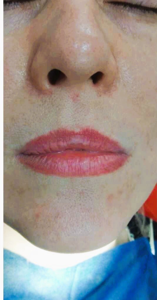 Lower face harmony before