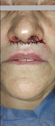Lip lift after