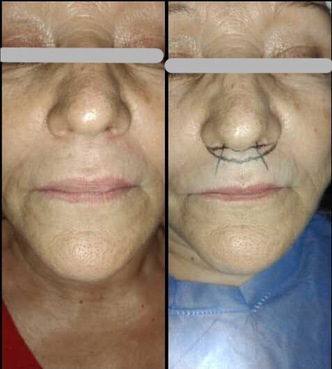 Lip lift before