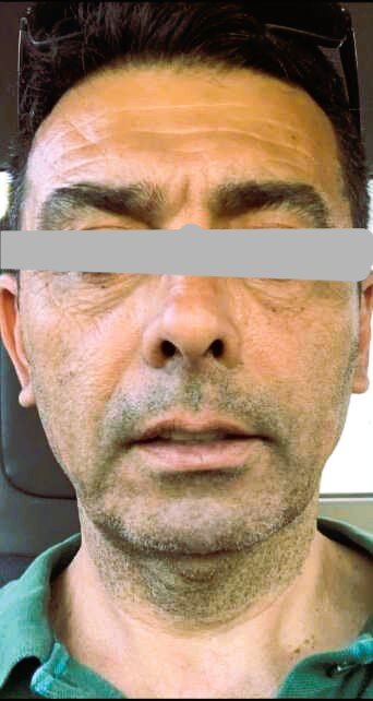 Facial rejuvenation after