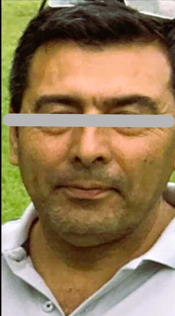 Facial rejuvenation before