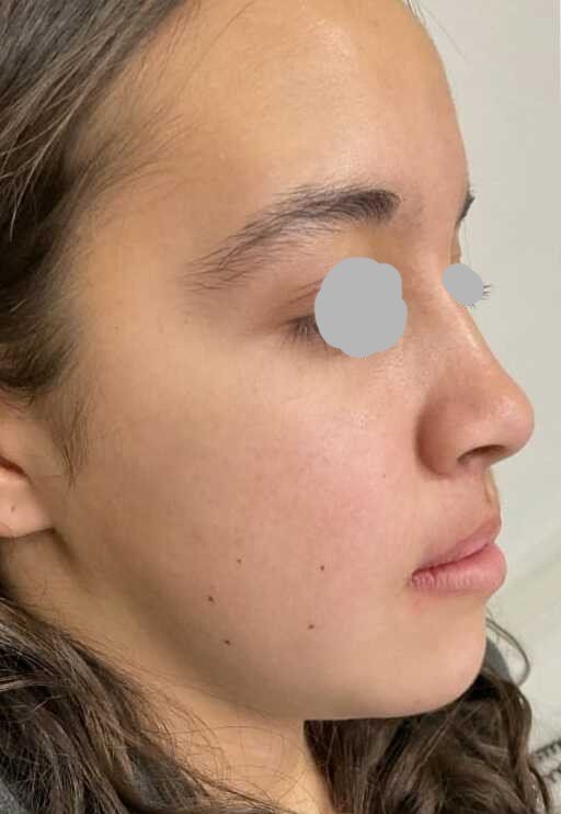 Orthognathic surgery after