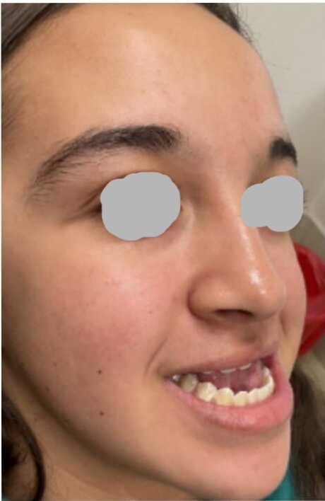 Orthognathic surgery before