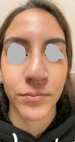 Facial balance before