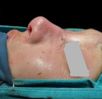 Profile rejuvenation after