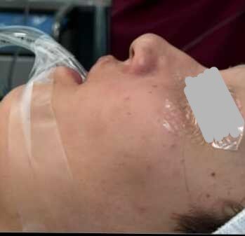 Profile rejuvenation before