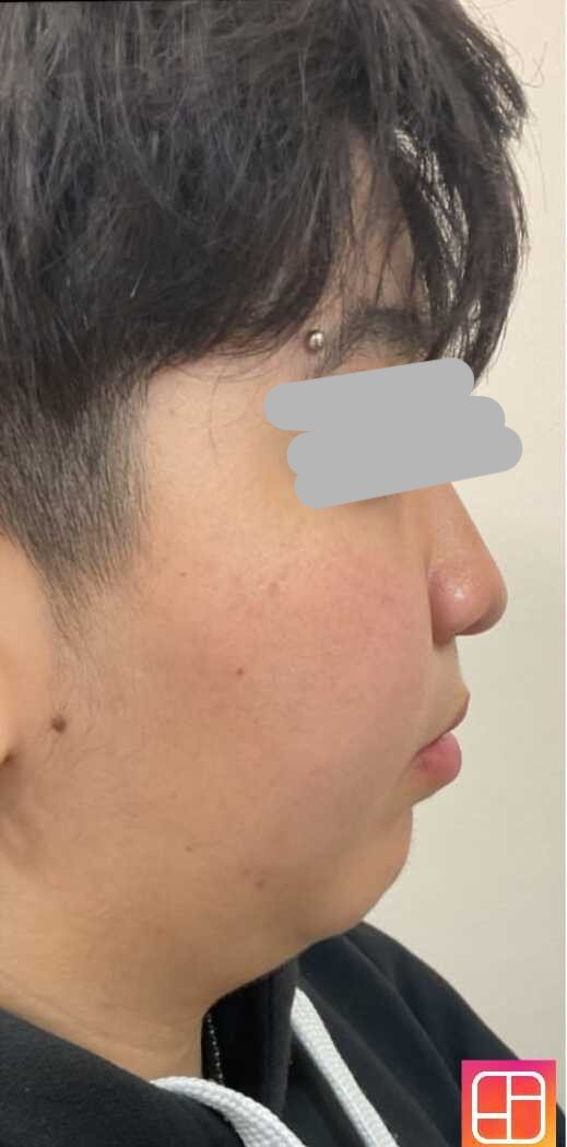 Upper jaw surgery after