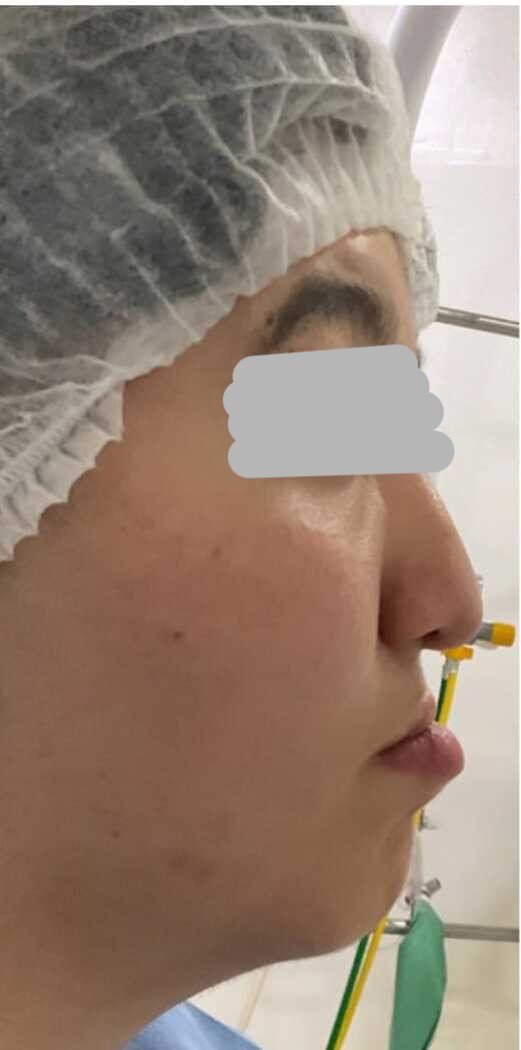 Upper jaw surgery before
