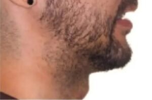 Jawline contouring result in Dubai